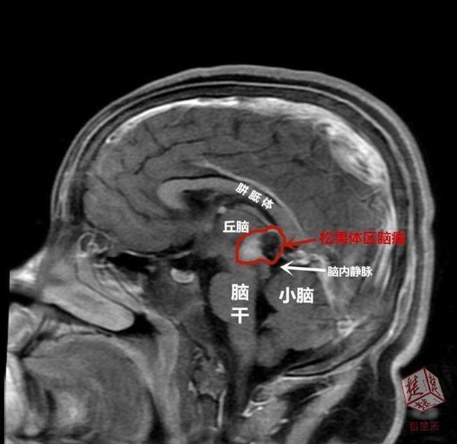 探索头痛深层原因，头痛频发，如何寻找解决方案？