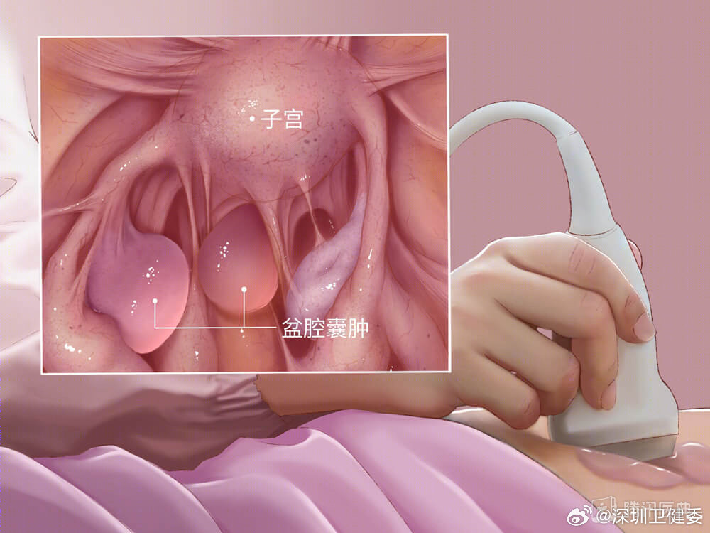 痛经困扰下的抉择，子宫切除背后的故事与思考