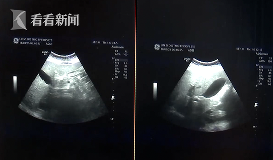 小男孩CT检查出少量盆腔积液，关注与探索其背后原因